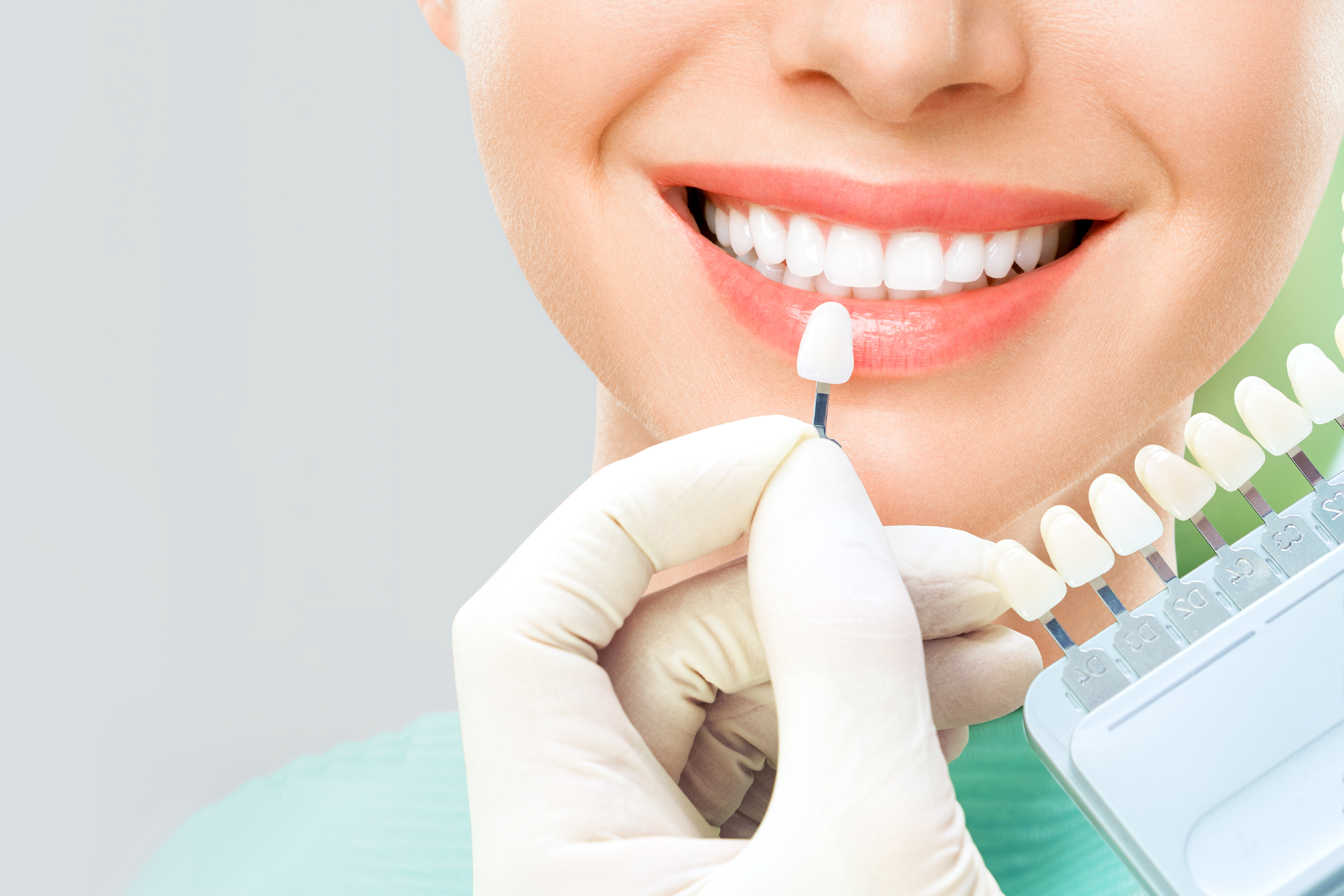 Tooth Whitening Bleaching