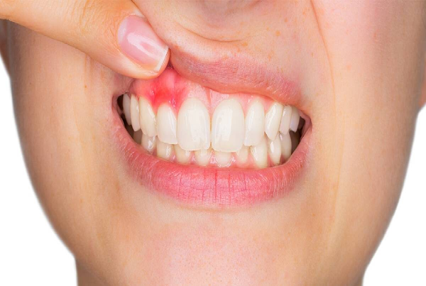 Treatment of Pyorrhea and Bleeding Gums