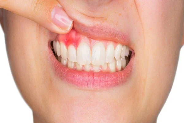 Treatment of Pyorrhea and Bleeding Gums