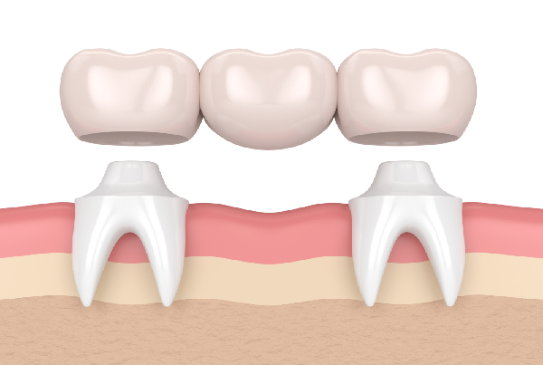 Fix Crown and Bridge